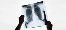 X-ray of chest and lungs